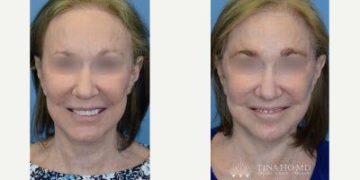 65-74 year old woman treated with Facelift Revision, Neck Lift - 66 year-old female with prior history of eyelid surgery who underwent revision upper blepharoplasty for eye rejuvenation.