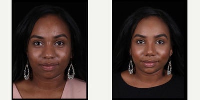 25-34 year old woman treated with African American Rhinoplasty - Since we preserve the nasal dorsum, we can perform this surgery without using costal cartilage. This approach provides significant comfort for many patients. Although it is not possible in every case, if the septal cartilage is sufficient in both quantity and strength, it offers a considerable advantage