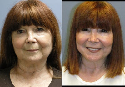 Facelift - 
	The Lite Lift (TM) is a modified facelift that can be performed in office under local anasthesia to improve signs of aging around the neck, jawline and lower face. Because of limited incisions there is little bruising and swelling and the recovery time is very quick, most patients can be back to work within two weeks.
