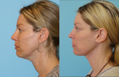 Facelift - 
	This patient came to the office looking to tighten up the sagging skin of her neck and jowl. Using a sub-SMAS Minilift, Dr. Balikian was able to sharpen the neck line, redfine the jawline and soften the marriontte lines. Note the imperceptable incision tucked in behind the ear cartilages.
