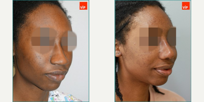 [African American Rhinoplasty] 25-34 year old woman treated with Rib Cartilage Rhinoplasty - African American Female with 100% Rib Cartilage Rhinoplasty