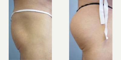 Woman treated with Butt Implants - Woman treated with Butt Implants