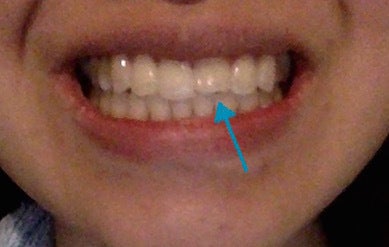 Best options for straightening front teeth