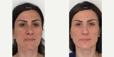Woman treated with Coolaser, Laser Resurfacing, Skin Lightening - Treatment: Coolaser Skin ResurfacingPurpose: To treat melasma, skin discoloration, sun damage, sunspotsHow it works: Using CoolaserResults: Will be seen in a few days to weeksNote: Individual results may varyTechnique: Coolaser and/or Bluelight dual treatmentAnesthesia: Topical onlyTime it takes: 30 minutes to 60 minutesRecovery: 1-7 daysLasts: Semi-PermanentCaution: Must be performed by an experienced providerPain level: Varies Mild to moderateNumber of sessions recommended: 1-3.