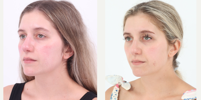 25-34 year old woman treated with BroadBand Light (BBL) - Before and after 3 sessions of BBL to treat rosacea