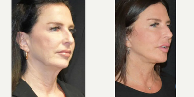 Woman treated with Facelift - This patient is 6 months post-op facelift and fat transfer.
