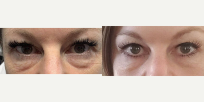 45-54 year old woman treated with Microneedling - Gender: FemaleEthnicity: CaucasianAge: 41 - 50Procedure: Agnes RF