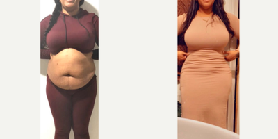 35-44 year old woman treated with Tummy Tuck, Liposuction, Brazilian Butt Lift - Full tummy tuck with Intense Liposuction and Dominican Butt lift