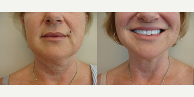 55-64 year old woman treated with Tickle Lipo - Tumescent liposuction of the chin, cheeks, and jowls