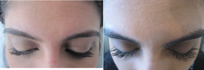 Latisse - Eyelash Growth - Eyelash growth after 16 weeks.