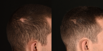 25-34 year old man treated with Hair Loss Treatment - Our blood consists of two main components, red blood cells and plasma. The plasma contains white blood cells and platelets that are rich in growth factors. By extracting and isolating these growth factors, specifically the platelet-rich fibrin or #PRF, we can harness the all-natural regenerative properties to stimulate the activity of hair follicles to promote new hair growth. There are no additives to this meaning this all-natural treatment is entirely from ones own body. Anyone experiencing hair loss is essentially a good candidate for PRF treatments, especially those who are experiencing early signs of hair loss.