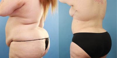 25-34 year old woman treated with Breast Lift, Tummy Tuck, Liposuction, Nipple Surgery - Patient is 3 months post 360 liposuction tummy tuck, breast lift with nipple graft. Patient is very happy with her results, stated that it was life changing.