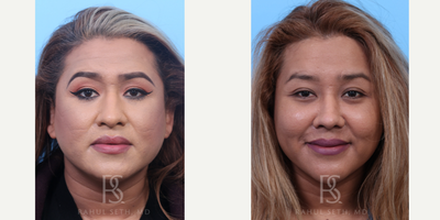 35-44 year old transgender woman treated with Facial Feminization Surgery, Transgender Facial Feminization Surgery - Comprehensive facial feminization surgery - browlift, forehead and orbital bone contouring, rhinoplasty, alar base reduction, jaw and chin reduction, cheek fat grafting, neck liposuction.