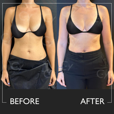 25-34 year old woman treated with Breast Lift - Breast Lift by M.D. Gray Yeiladal