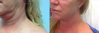 45-54 year old woman treated with JuVaShape - Radio Frequency JuVaShape fat melting + skin tightening (package of 4 treatments)
