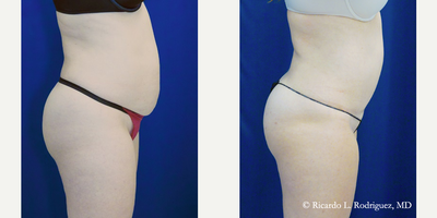 Woman treated with Tummy Tuck, Liposuction - Woman treated with Tummy Tuck, Liposuction