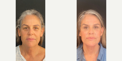 Woman in her early 60s treated with CO2 Laser - Woman in her early 60s treated with CO2 Laser Resurfacing to improve texture of skinas well as Deep Plane Facelift to enhance jowls, cheeks, and jawline, Neck Lift, Brow Lift,Facial Fat Transfer to tear troughs and cheeks junction, andLip Lift for a youthful pout.