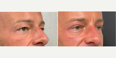 Man treated with Eyelid Surgery - Man treated with Eyelid Surgery