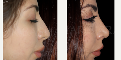 Woman treated with Sinus Surgery - Blocked Nose