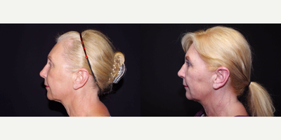 55-64 year old woman treated with ArteFill - 64 year old female received Bellafill to the nasolabial folds and marionettes; photos depict the patient's results 4 months post-treatment.