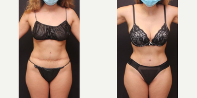 Woman treated with Tummy Tuck Revision - Woman treated with Liposculpture along with Tummy Tuck Revision