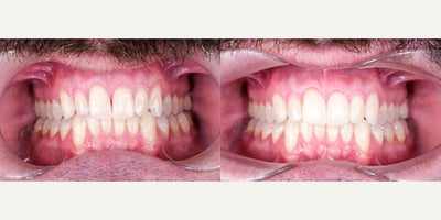 35-44 year old man treated with Porcelain Veneers, Dental Bonding - This patient wanted a complete smile transformation, including closing gaps and enhancing tooth shape. We used full ceramic crowns on both upper and lower arches to rebuild structure, improve symmetry, and achieve a brighter, more balanced look. The result is a dramatic yet natural changeand a confident new smile.