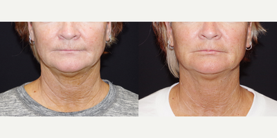 45-54 year old woman treated with Belotero - 53 year old female received 5 syringes of Belotero to the lower face and neck; photos depict the patients results 5 weeks post-op.