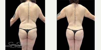 25-34 year old woman underwent a mommy makeover procedure (tummy tuck, VASER lipo, BBL, and breast augmentation) - 34 year old female underwent breast augmentation with silicone implants placed under the muscle through a small incision under the breasts. We corrected for size asymmetry of the breasts. We also performed a tummy tuck with muscle repair (abdominoplasty with diastasis recti repair), VASER assisted liposuction of the flanks and back, and a BBL (fat transfer for the buttocks and hips). Patient underwent 6 lymphatic massages post-op, and is currently undergoing Silagen scar therapy.