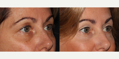 45-54 year old female treated with Eyelid Surgery - Upper Eyelid Surgery