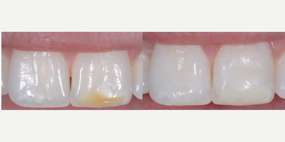 Patient treated with Tooth Repair - Certain discoloration on teeth can not be whitened. Some people spend their entire lives with an unattractive stain that they think can not be removed. We have great news! Here at the Goldstein Dental Center stains dont stand a chance! For this particular patient, the tooth was prepped, and tooth-colored resin was added to cover the discoloration. The procedure only took 1 hour, and no anesthetic was needed.