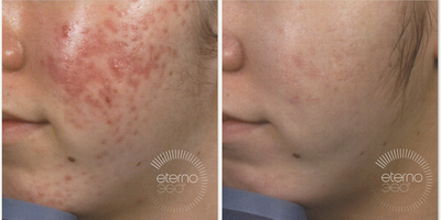 25-34 year old woman treated with EndyMed 3Deep - Before and after of our new treatment EndyMed. One of the treatments that uses this innovative radio frequency technology is FSR (Fractional Skin Resurfacing) which can have incredible results like this by improving scar quality and smoothing and tightening the skin. 