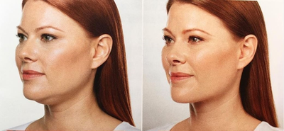 Woman treated with Kybella - Woman treated with Kybella.