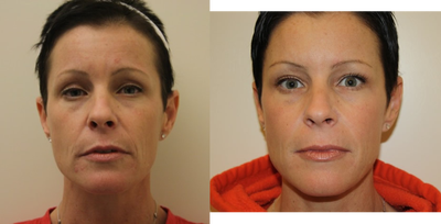 Sculptra Aesthetic on the face - Sculptra Aesthetic for facial rejuvenation