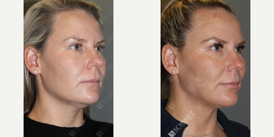 Woman treated with Chin Liposuction - Woman treated with Chin Liposuction