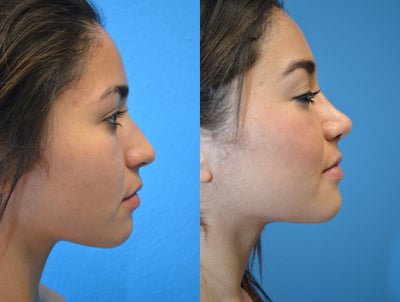 19 Year Old Nose - 
	19 Year Old with a slight bump on her nose with outstanding and natural results after Rhinoplasty.
