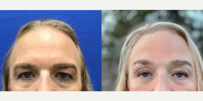 Transgender woman treated with Forehead Reduction - Transgender woman treated with Forehead Reduction