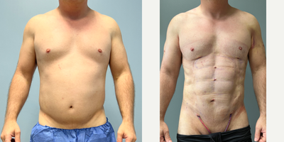 45-54 year old man treated with Abdominal Etching - 46 year old male who exercised regularly and good not get abdominal definition. Patient had HiDef abdominal and arm etching.