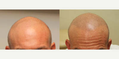35-44 year old man treated with Hair Loss Treatment Scalp MicroPigmentation SMP - Scalp MicroPigmentation SMP