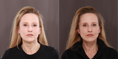 45-54 year old woman treated with MACS Facelift - Macslift (mini facelift)