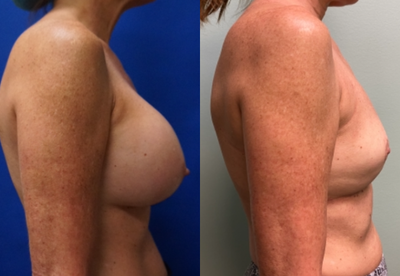 45-54 year old woman treated with Breast Implant Removal and Lollipop (Vertical Pattern) Breast Lift - This patient presented with 400 cc smooth saline implants that were placed underneath the muscle. She underwent breast implant removal (explant) with total capsulectomy and a lollipop (vertical pattern) breast lift. Note that there is no scarring in the breast fold.