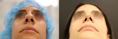 29 year old woman treated with Rhinoplasty - Female patient aged 29 treated with an open rhinoplasty (nose surgery). After photo was taken 9 months post-op.