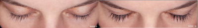 25-34 year old woman treated with Latisse - Latisse