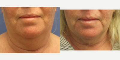 55-64 year old man treated with Kybella, Nonsurgical Neck Lift, Neck Lift - 59 year old female before, 5 weeks and 18 months after 2cc of Kybella injections to submental area. This is a non-surgical 5 minute treatment with minimal downtime and no incisions. Most people do 3 to 5 separate sessions with 40 different injections. Dr. Speron numbs the patient completely so they feel no pain and essentially does this injection the same way he does liposuction treating the different fat compartments because he is comfortable with the neck anatomy. Of course, this patient did not get her muscles tightened, or her skin removed or lifted, which would've given her a more dramatic result. She is very happy with the smaller neck and tightened skin and still does not wish to undergo surgery or laser treatment or any other interventions.
