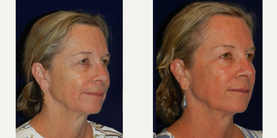 55-64 year old woman treated with DefenAge - 60 year old woman treated with Morpheus8 while using DefenAge skincare.