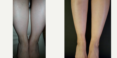25-34 year old woman treated with Liposuction Revision - pt had Liposuction done for the inner calves which left her with asymmetrical legs and cankles Microsculpting was done to fix the inner leg asymmetry and to sculpt the ankles. this is her result 6 months post procedure. as you can see the surgery not only corrected the asymmetry but also made her legs look longer.