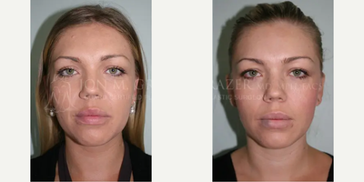 Woman treated with Mole Removal - Woman treated with Mole Removal