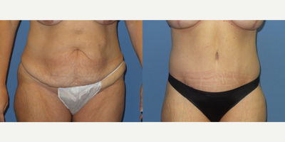 45-54 year old woman treated with Body Lift - 46 y/o female shown one year after a lower body lift.