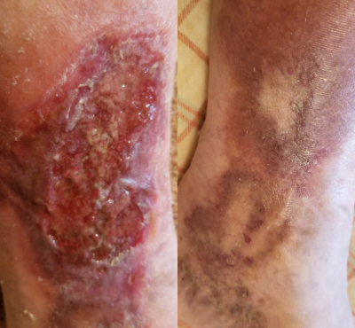 65-74 year old woman treated with EVLT - A 66-year-old female with 3 years history of leg ulcer, has been treated in the wound care centers for many months without help. After treating her dysfunctional varicose veins, her ulcer starts clearing slowly until it heals completely in 6 months.