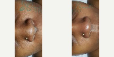 Woman treated with Dermaplaning - Woman treated with Dermaplaning