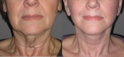 55-64 year old woman treated with Neck Lift - Patient presented with severe neck laxity and a classic turkey gobbler. A lateral necklift was performed with tightening of both the underlying muscle and skin to significantly improve her profile and submental (under the chin) area. She was back to work one week after procedure.
